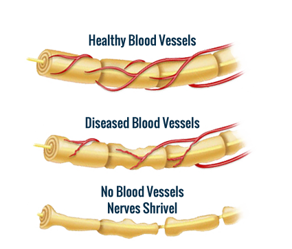 Neuropathy Foot Pain
